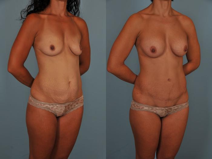 Before & After Tummy Tuck Case 17 View #4 View in Toronto, ON