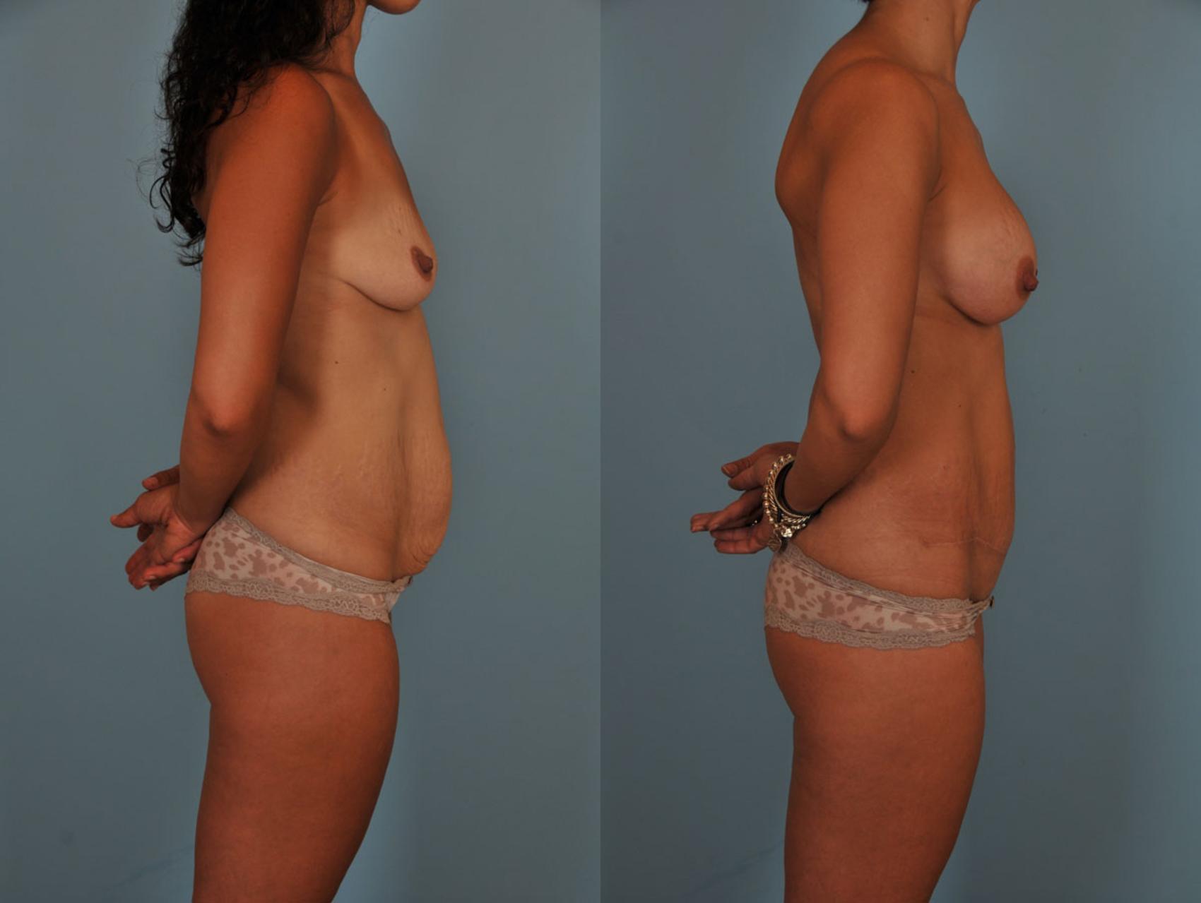 Before & After Tummy Tuck Case 17 View #5 View in Toronto, ON