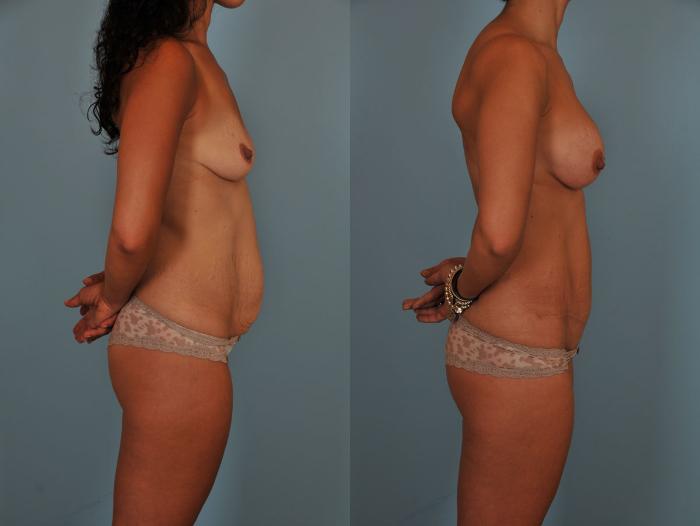 Before & After Tummy Tuck Case 17 View #5 View in Toronto, ON