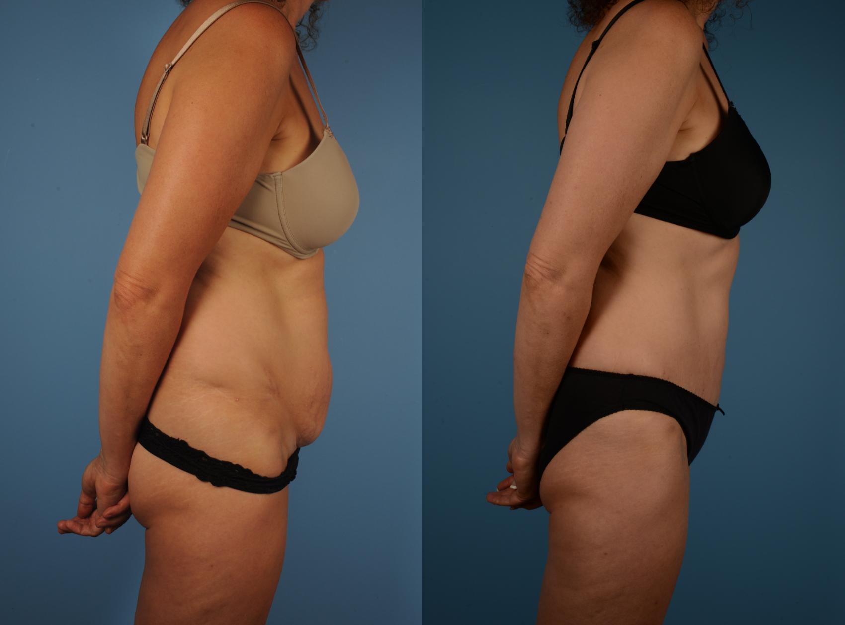 Before & After Tummy Tuck Case 171 View #1 View in Toronto, ON