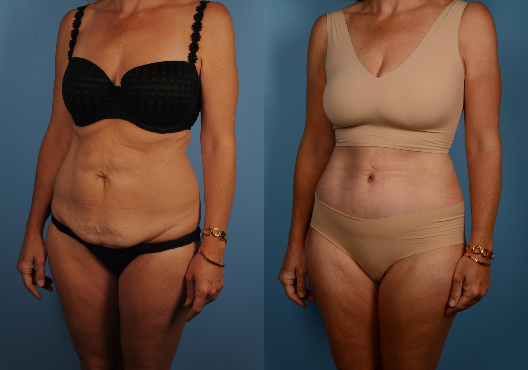 That Loose Tummy Skin Is Called a Panniculus—and Exercise Won't Fix It  (Photos)