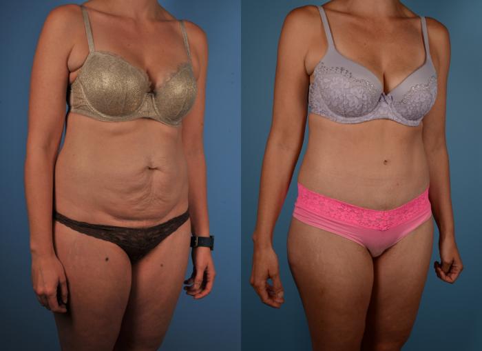 Before & After Tummy Tuck Case 180 View #1 View in Toronto, ON