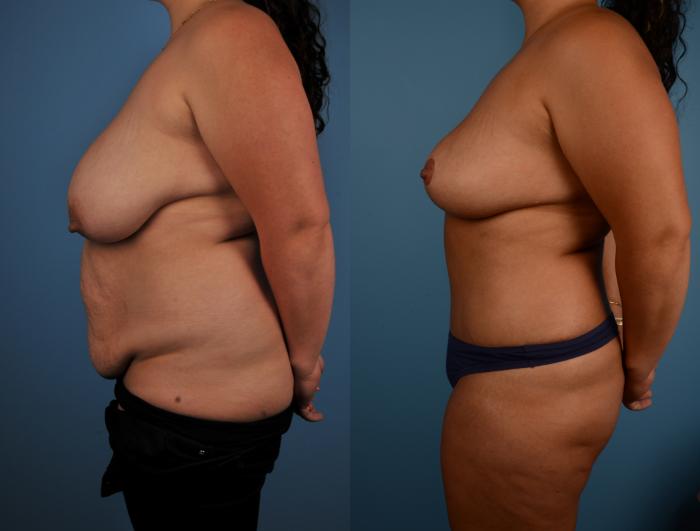 Before & After Tummy Tuck Case 216 View #1 View in Toronto, ON