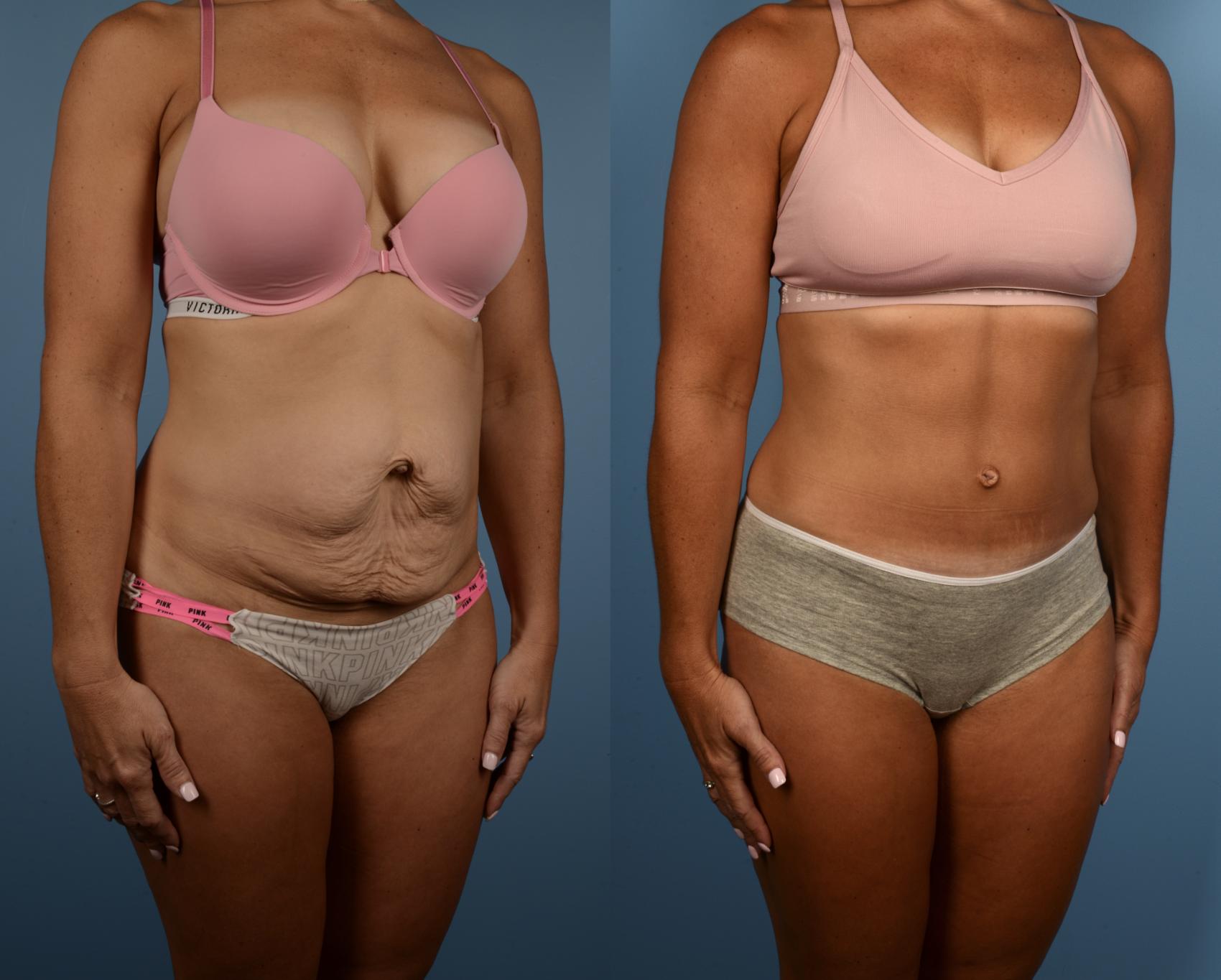 Before & After Tummy Tuck Case 220 View #1 View in Toronto, ON