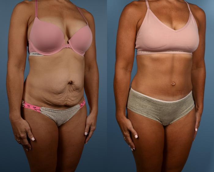 Before & After Tummy Tuck Case 220 View #1 View in Toronto, ON