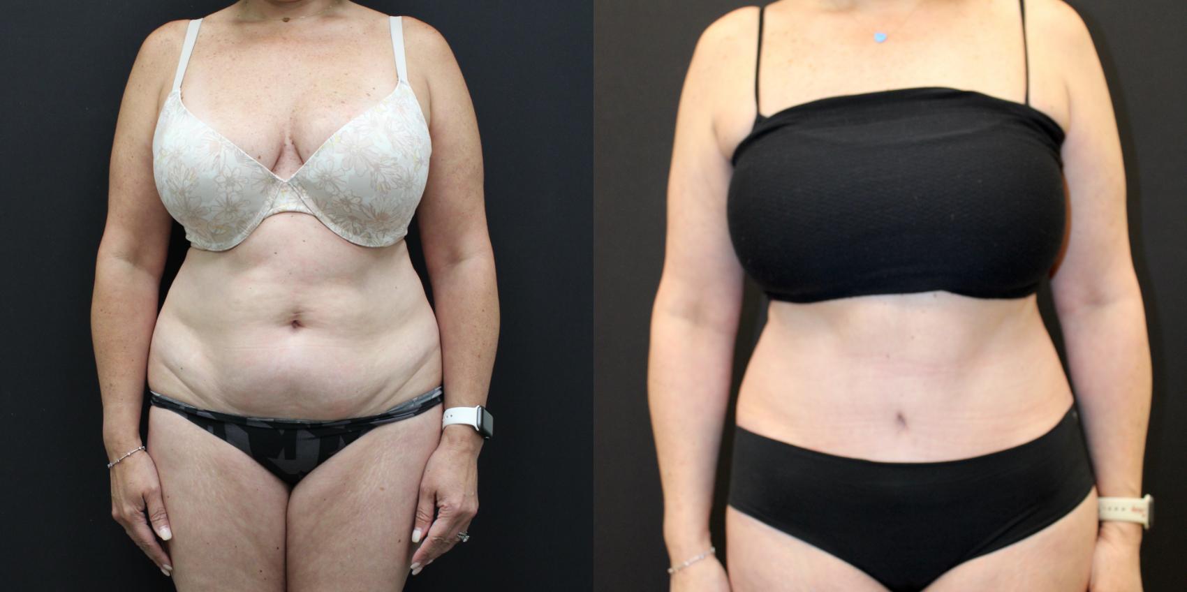 Before & After Tummy Tuck Case 267 Front View in Toronto, ON
