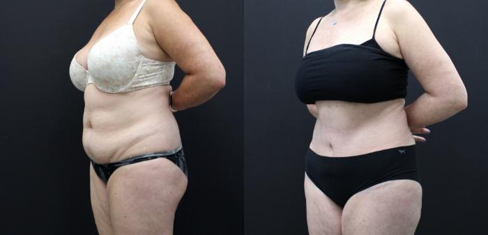 Before & After Tummy Tuck Case 267 Left Oblique View in Toronto, ON