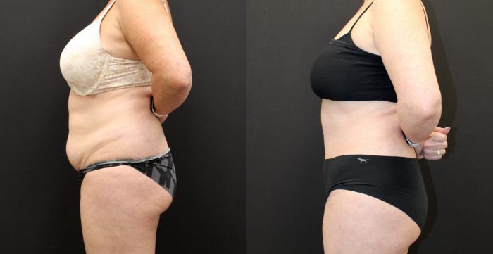 Before & After Tummy Tuck Case 267 Left Side View in Toronto, ON