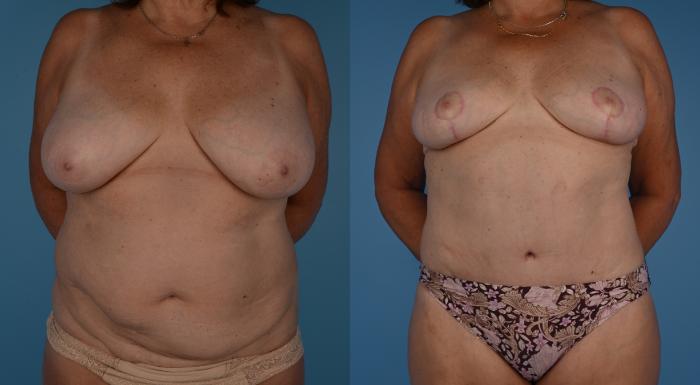 Complex Tummy Tuck, Complex Abdominoplasty, Before and After Photos, Dr. Steven Hanna, Toronto, Canada