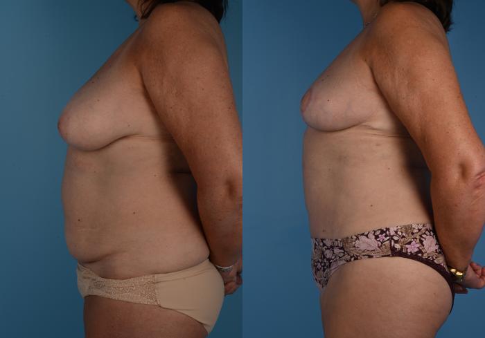 Tummy Tuck, Abdominoplasty, Before and After Photos, Dr. Steven Hanna, Toronto, Canada