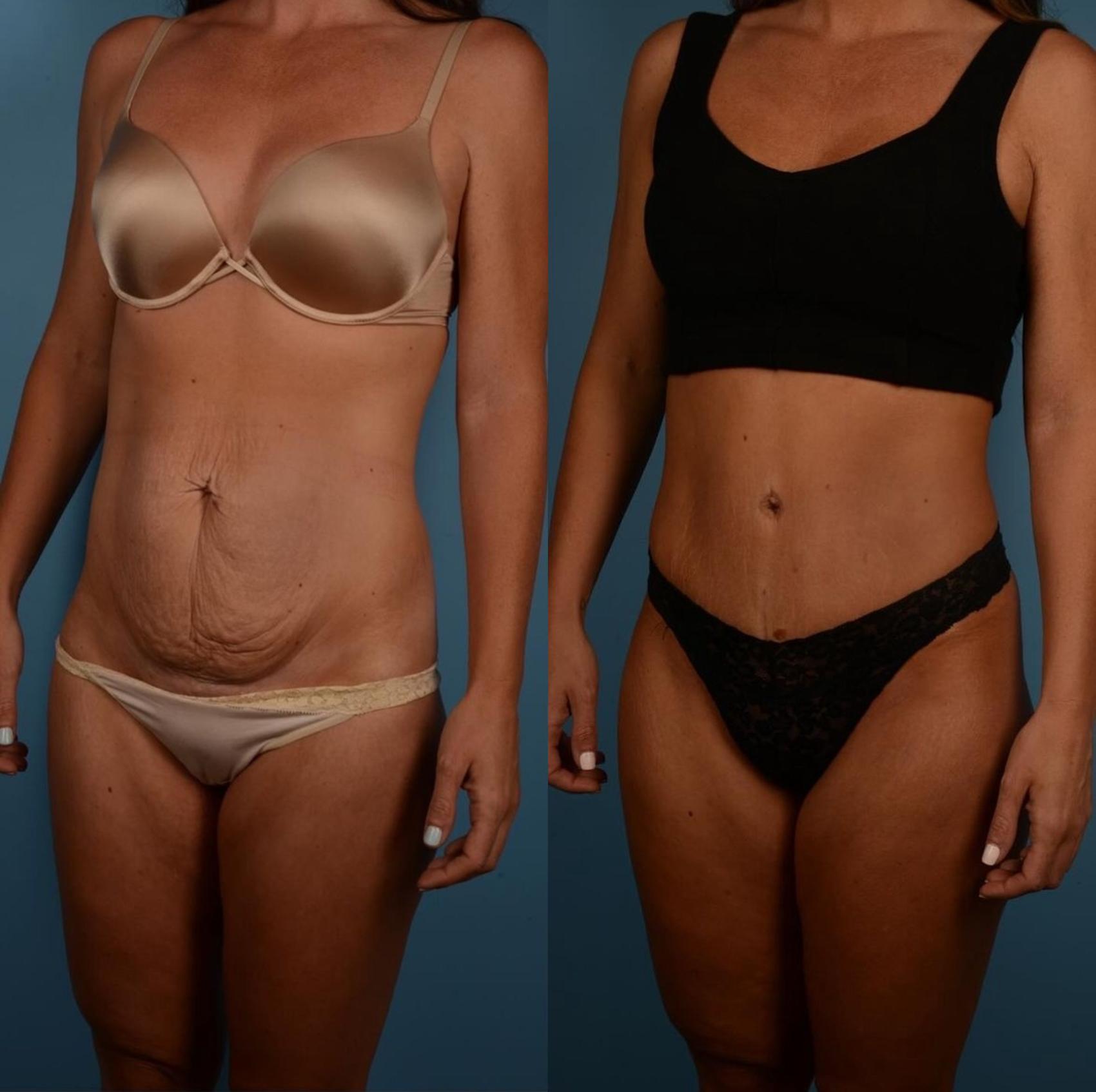 Before & After Tummy Tuck Case 298 Left Oblique View in Toronto, ON