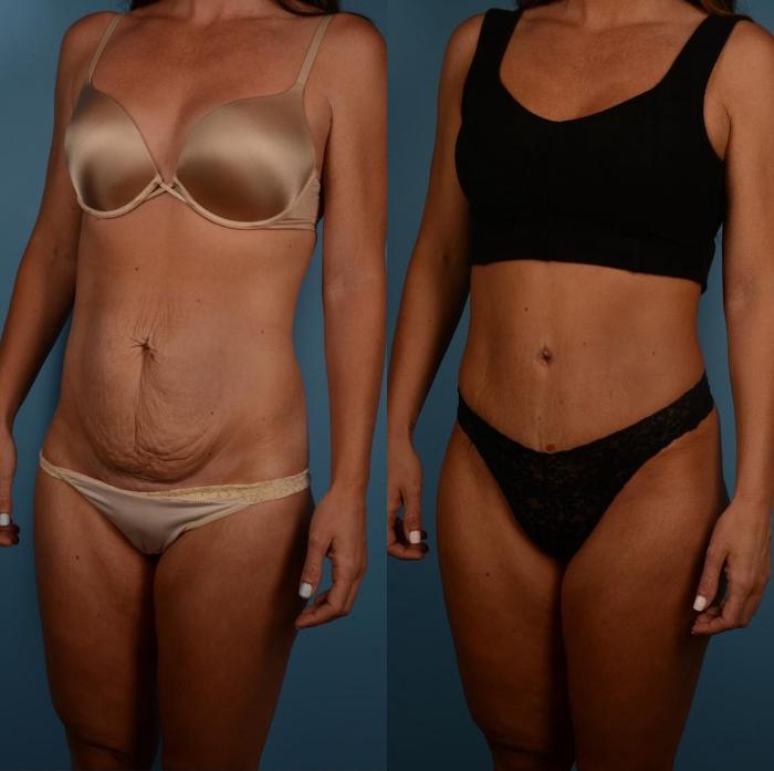 Before & After Tummy Tuck Case 298 Left Oblique View in Toronto, ON