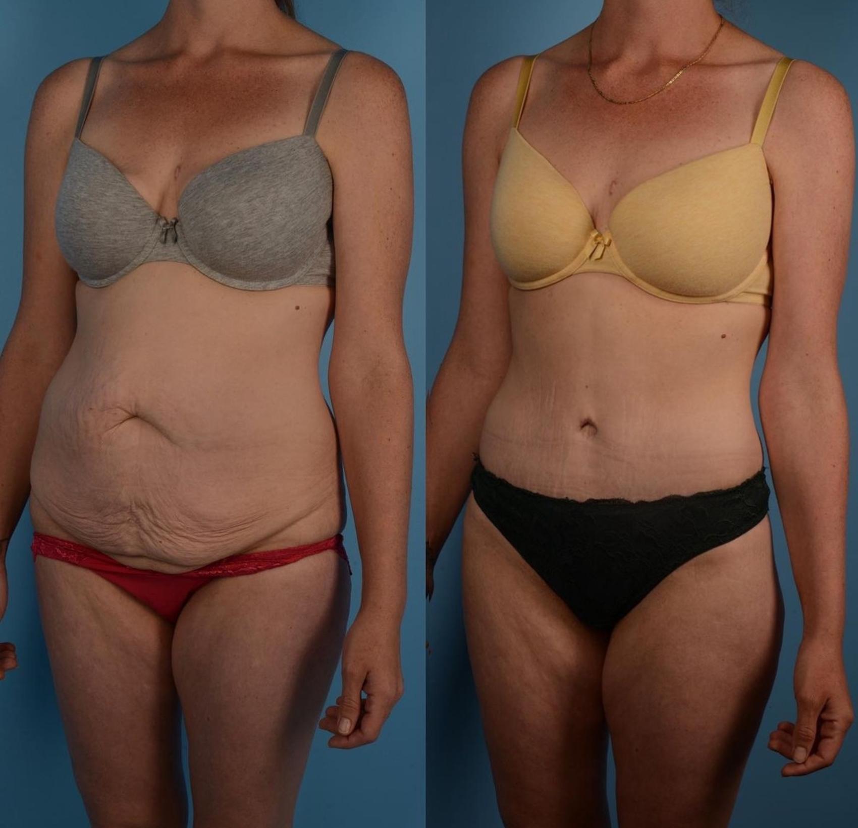 Before & After Tummy Tuck Case 299 Left Oblique View in Toronto, ON