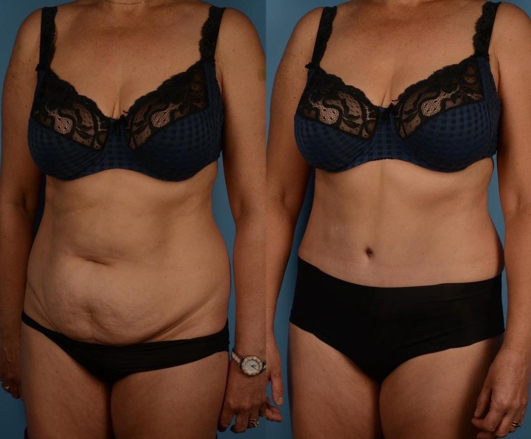 Before & After Tummy Tuck Case 300 Left Oblique View in Toronto, ON