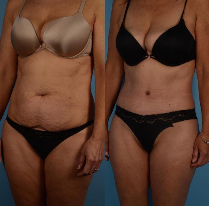 Before & After Tummy Tuck Case 301 Left Oblique View in Toronto, ON