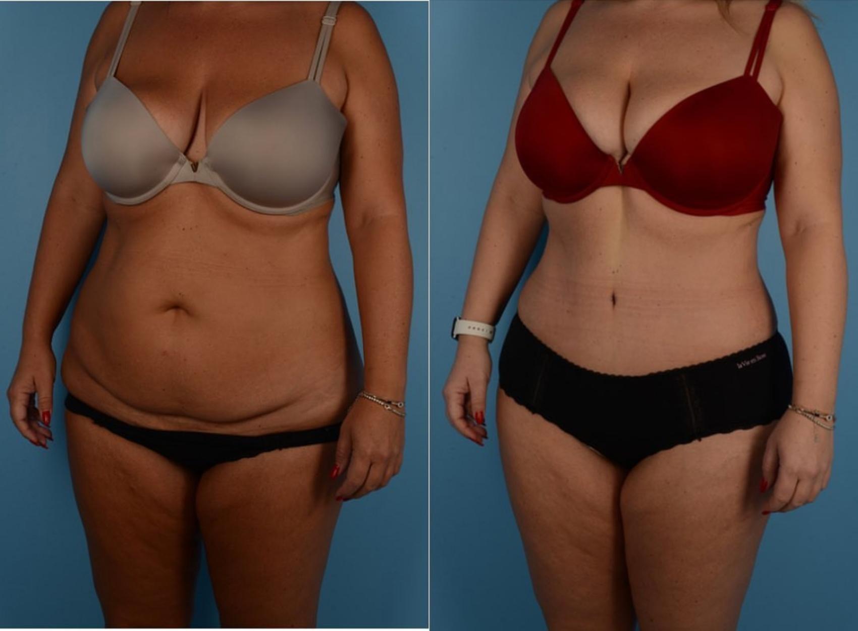 Before & After Tummy Tuck Case 302 Left Oblique View in Toronto, ON