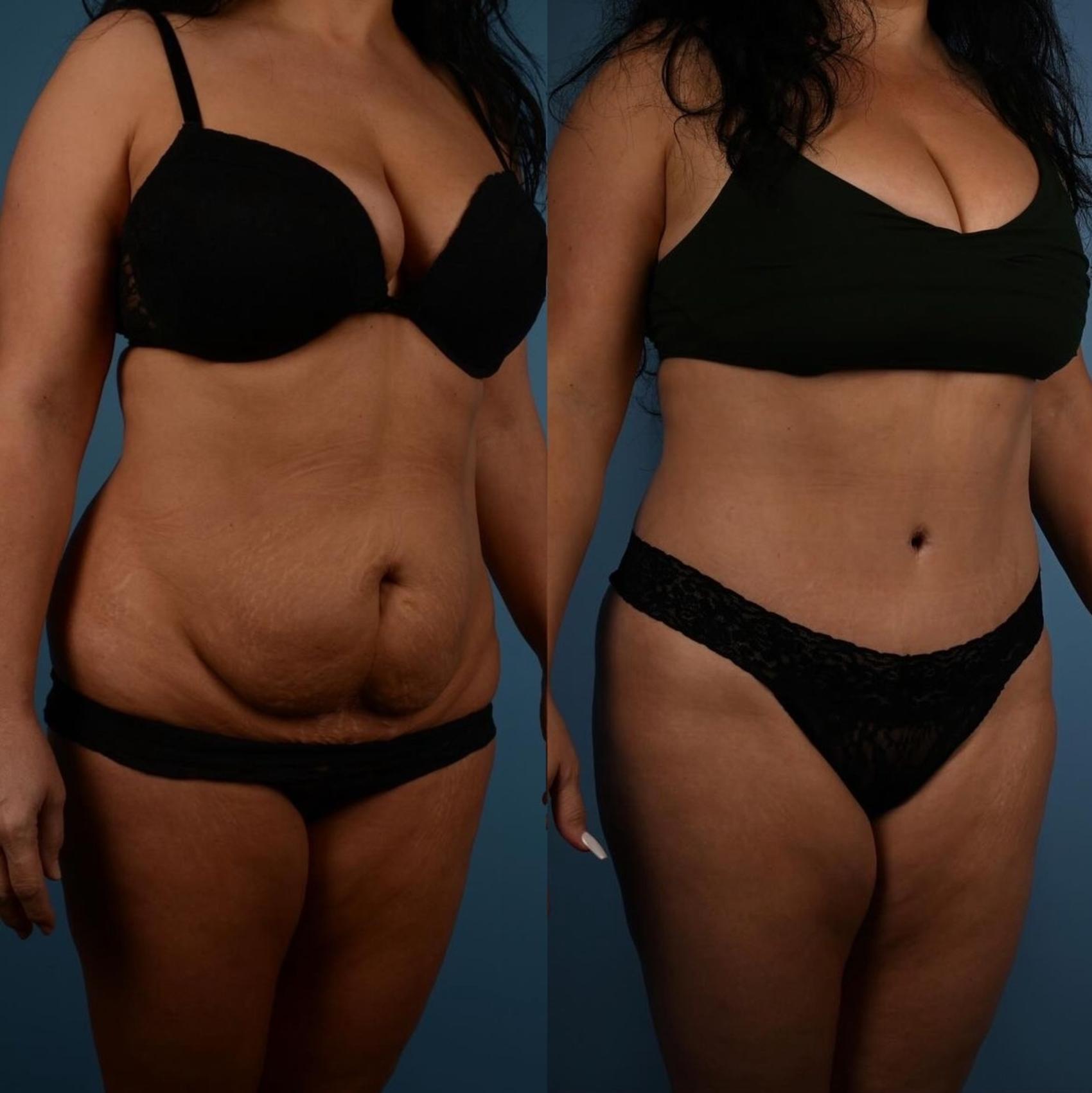 Before & After Tummy Tuck Case 304 Right Oblique View in Toronto, ON