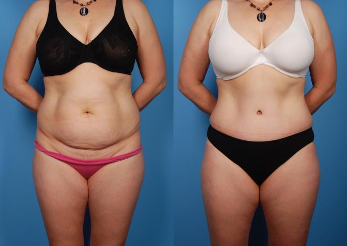 Before & After Tummy Tuck Case 36 View #1 View in Toronto, ON