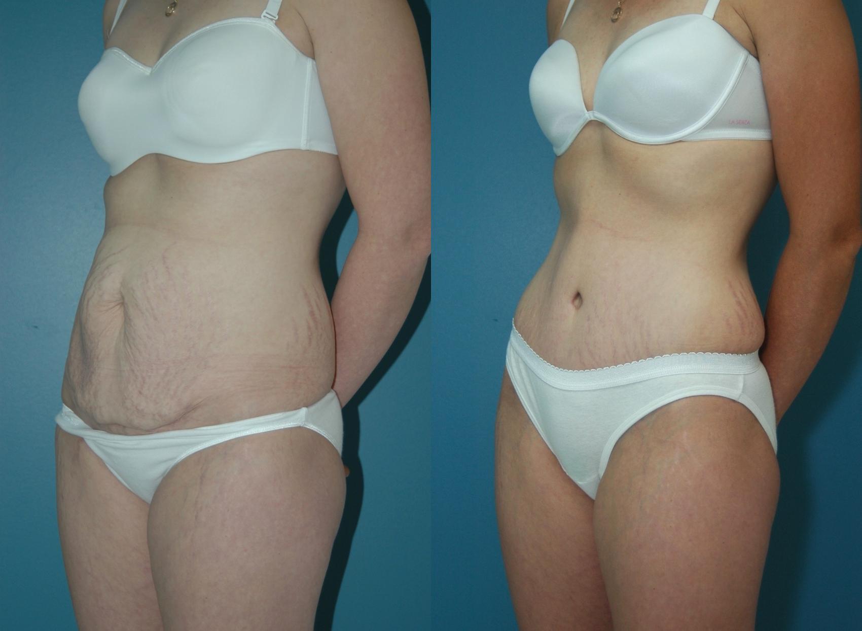 Before & After Tummy Tuck Case 37 View #1 View in Toronto, ON