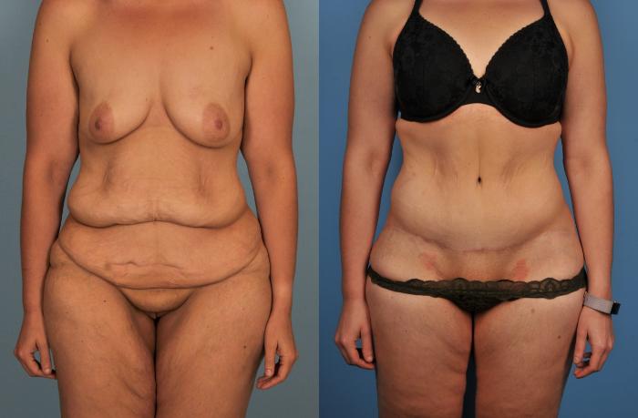 Before & After Tummy Tuck Case 82 View #1 View in Toronto, ON