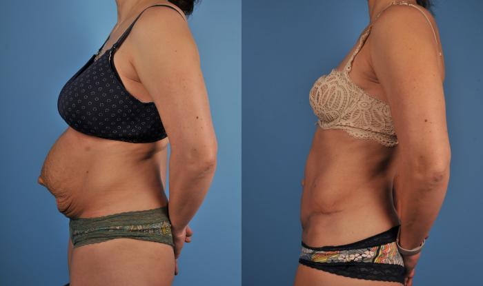 Before & After Tummy Tuck Case 88 View #1 View in Toronto, ON