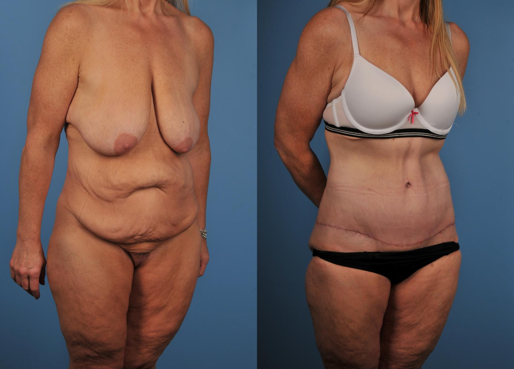 Before & After Tummy Tuck Case 93 View #1 View in Toronto, ON