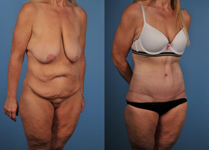 Before & After Tummy Tuck Case 93 View #1 View in Toronto, ON