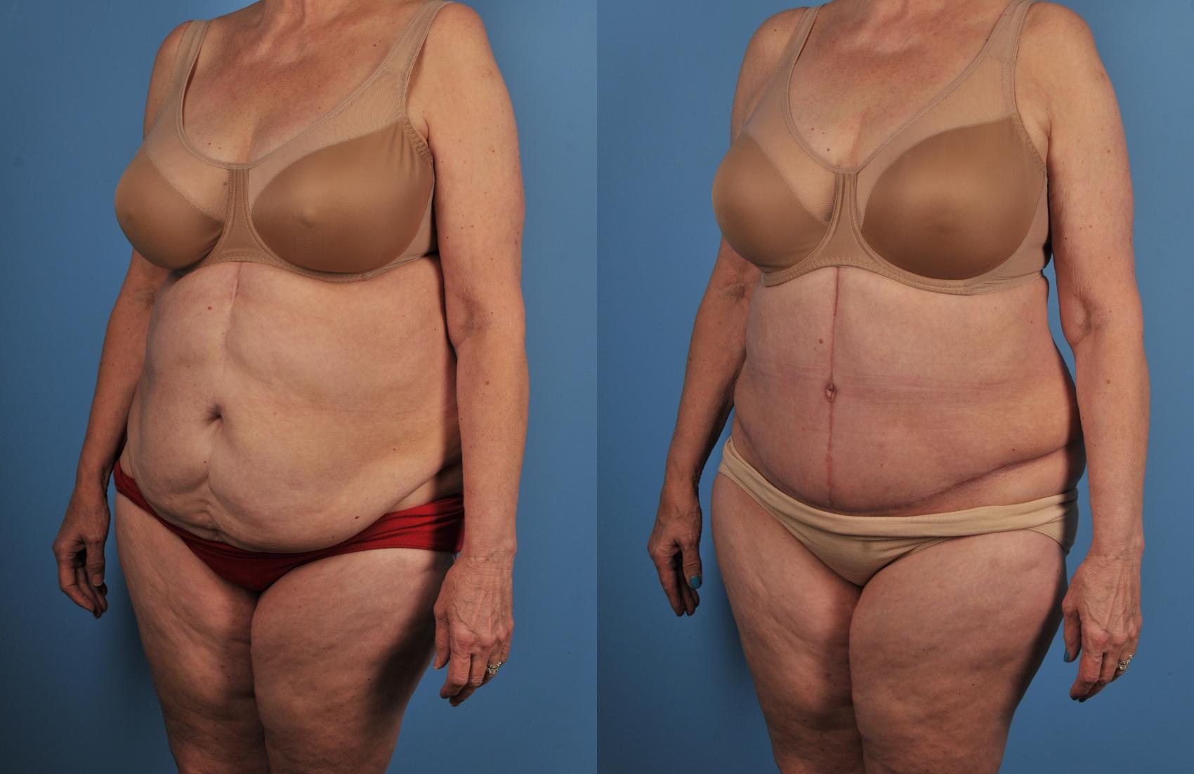 Before & After Tummy Tuck Case 96 View #1 View in Toronto, ON