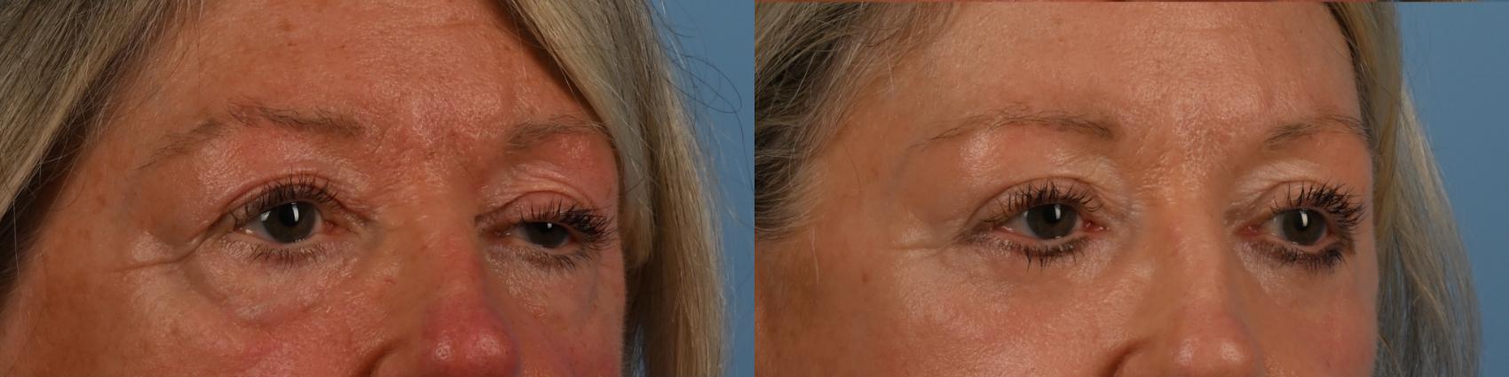 Before & After Upper Blepharoplasty with Ptosis Correction Case 330 Left Oblique View in Toronto, ON