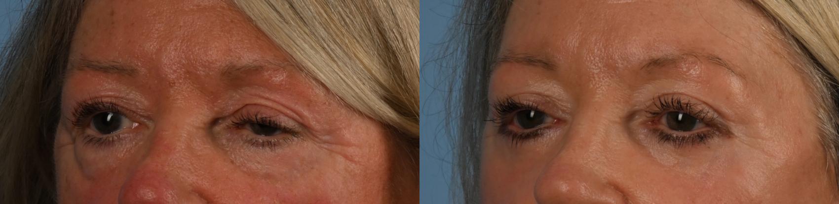 Before & After Upper Blepharoplasty with Ptosis Correction Case 330 Right Oblique View in Toronto, ON